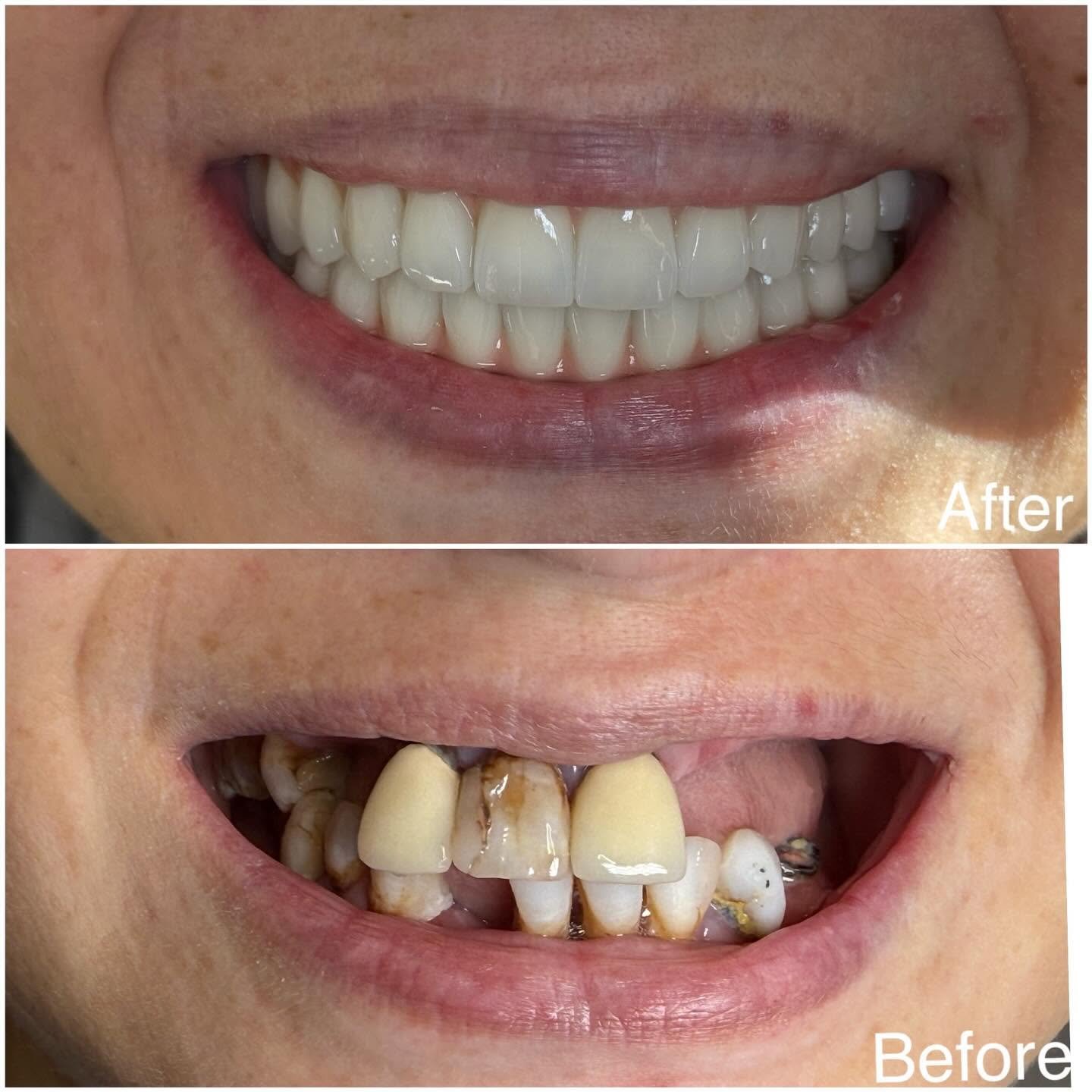 Cosmetic dentistry before and after result